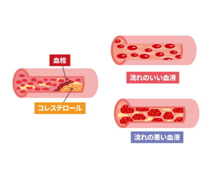 脂質異常症